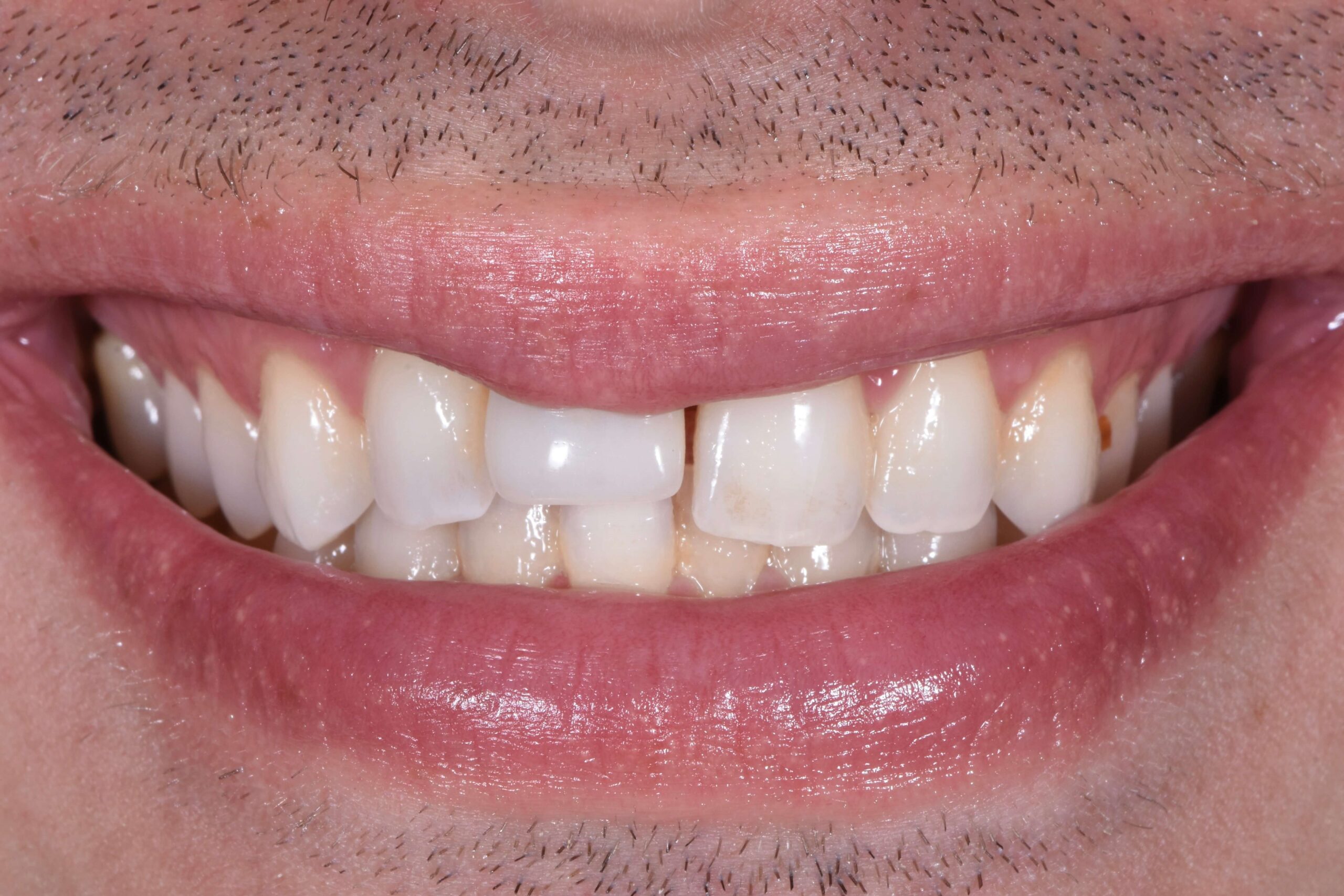 Dental Crowns — before