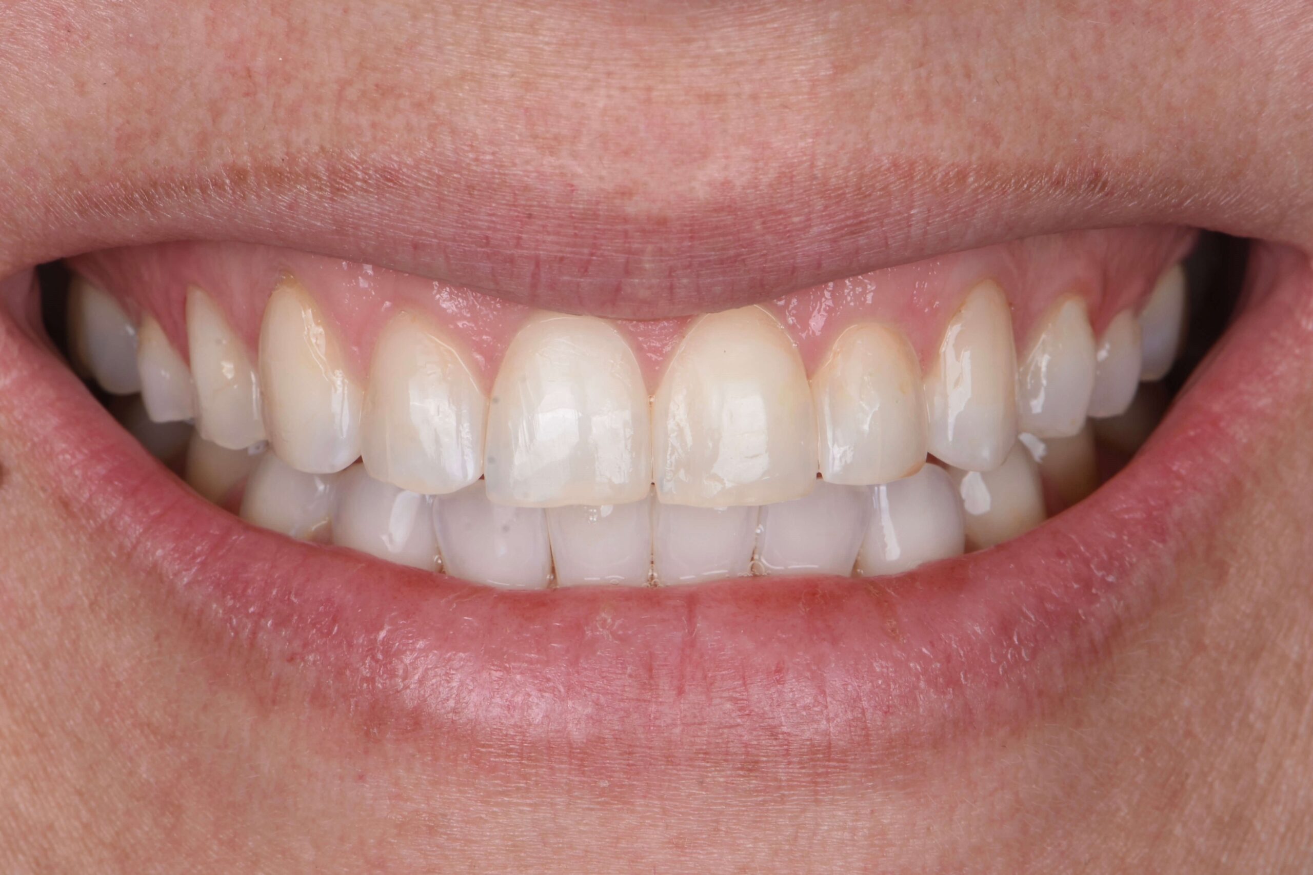 Invisalign® Treatment — before