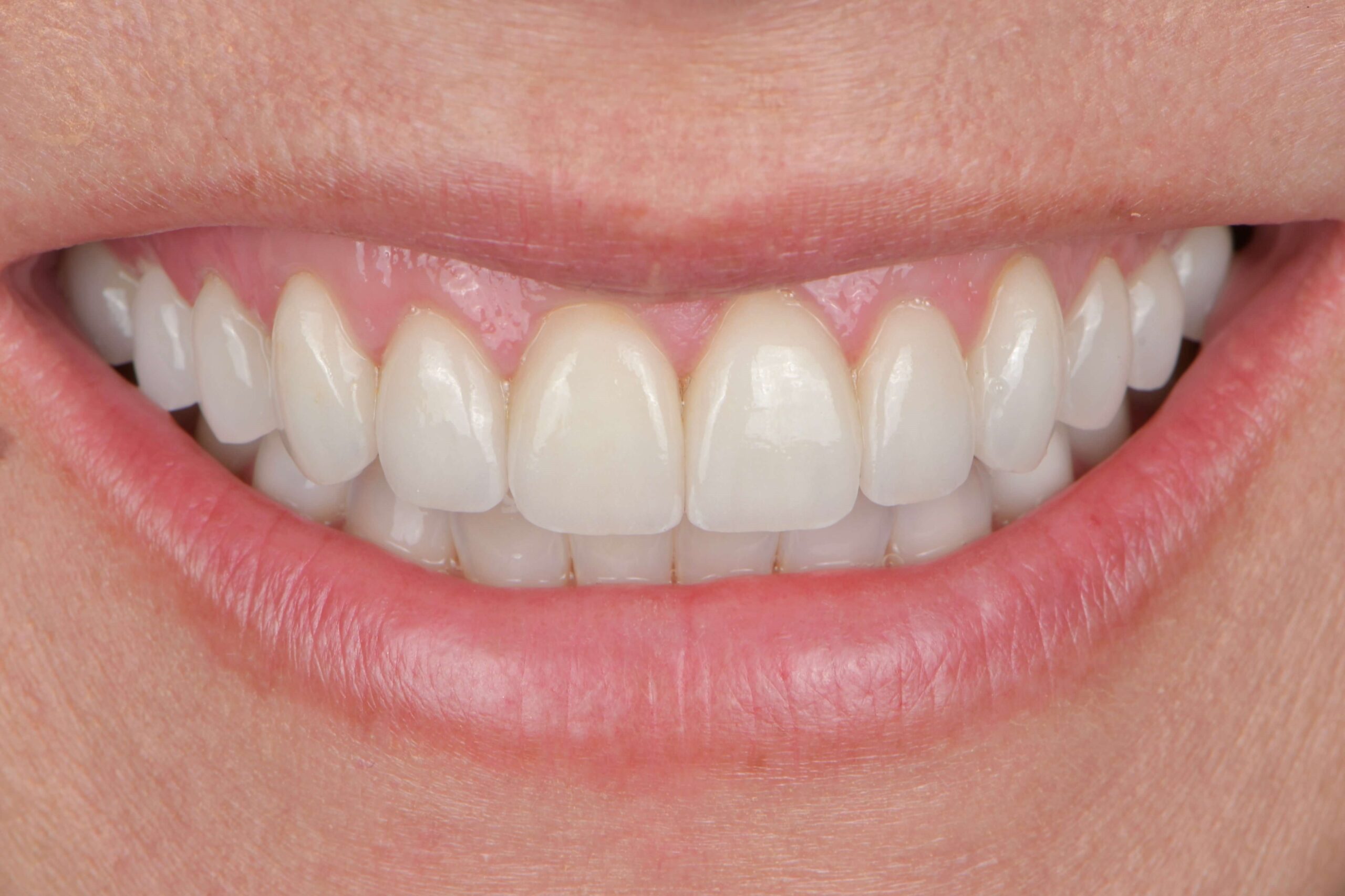 Invisalign® Treatment — after