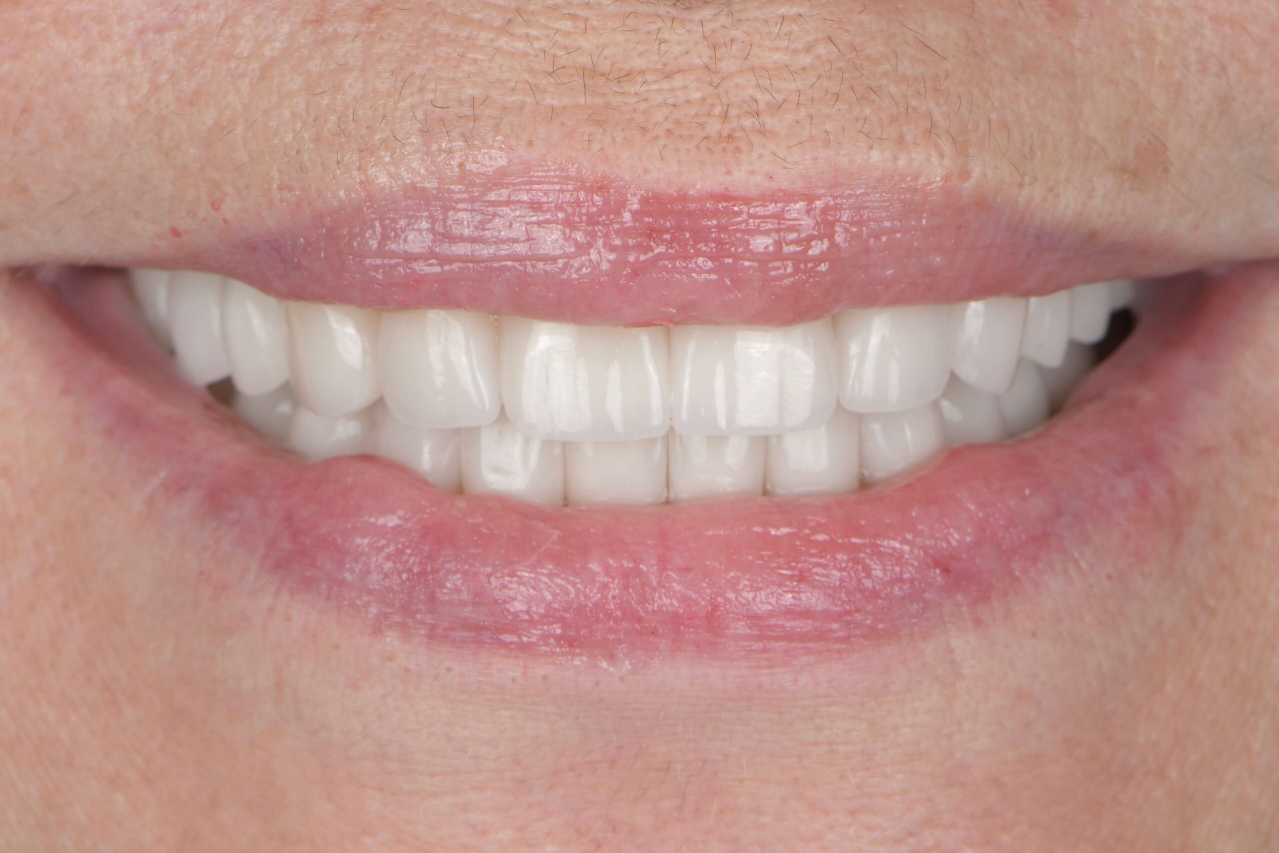 Smile Makeover — after
