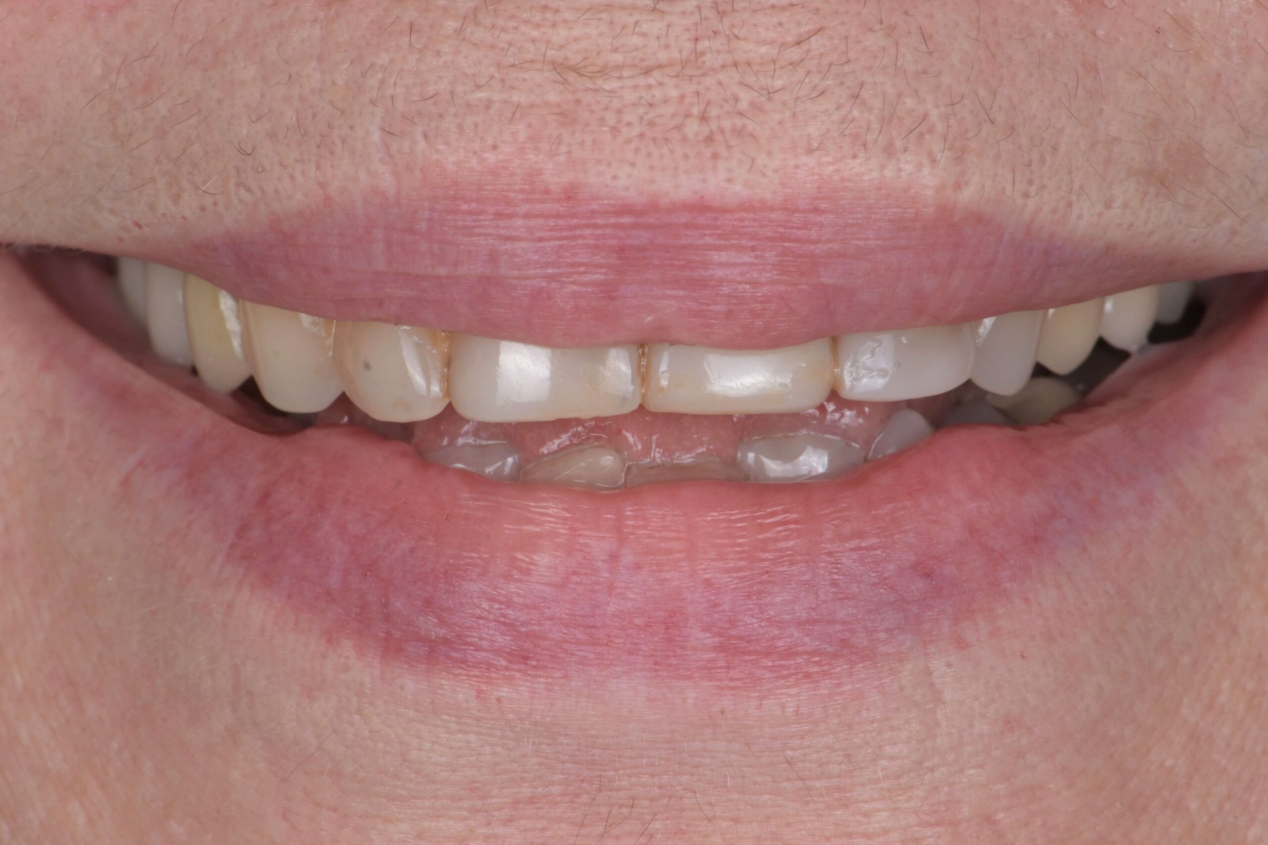Smile Makeover — before
