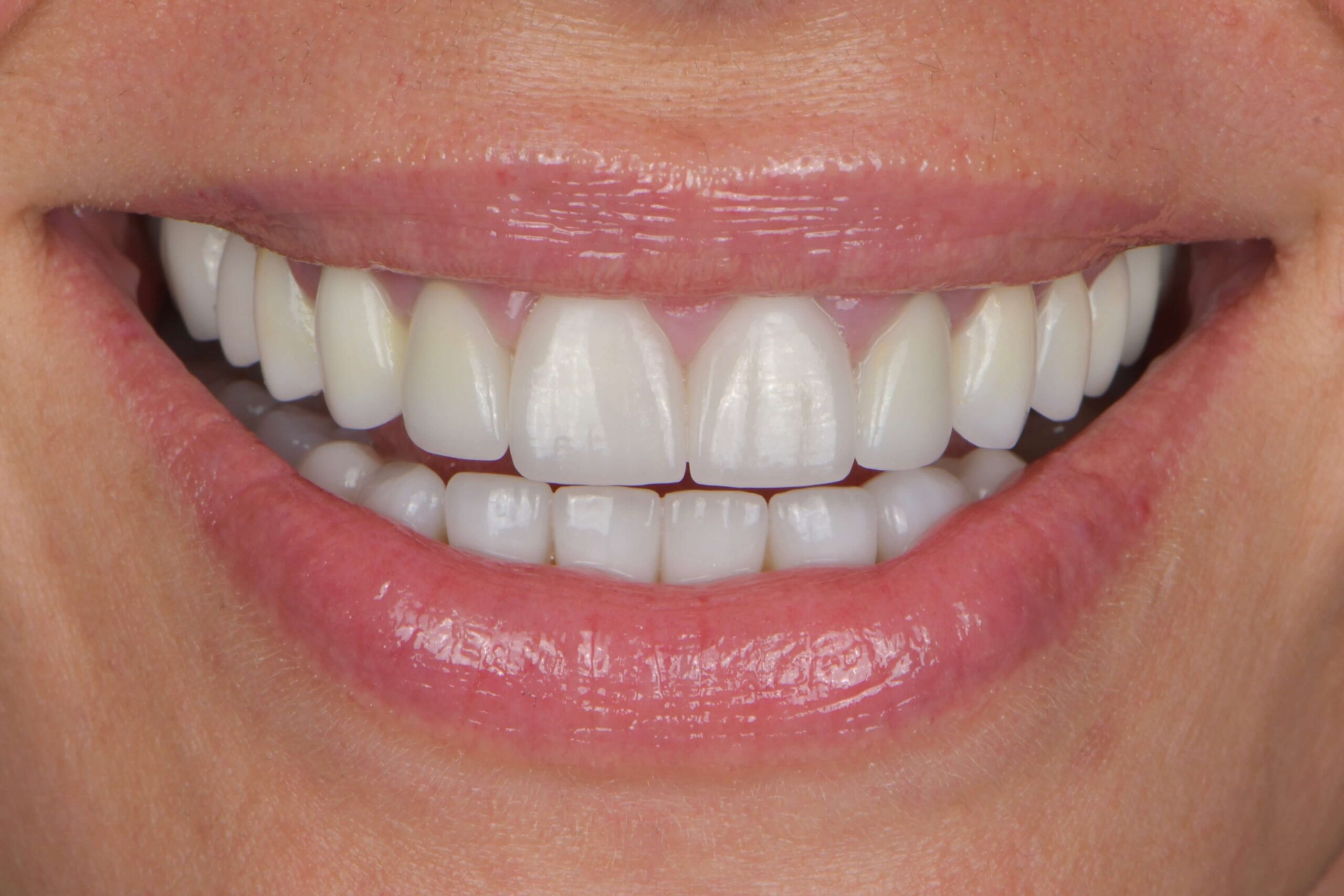 Invisalign® Treatment — after