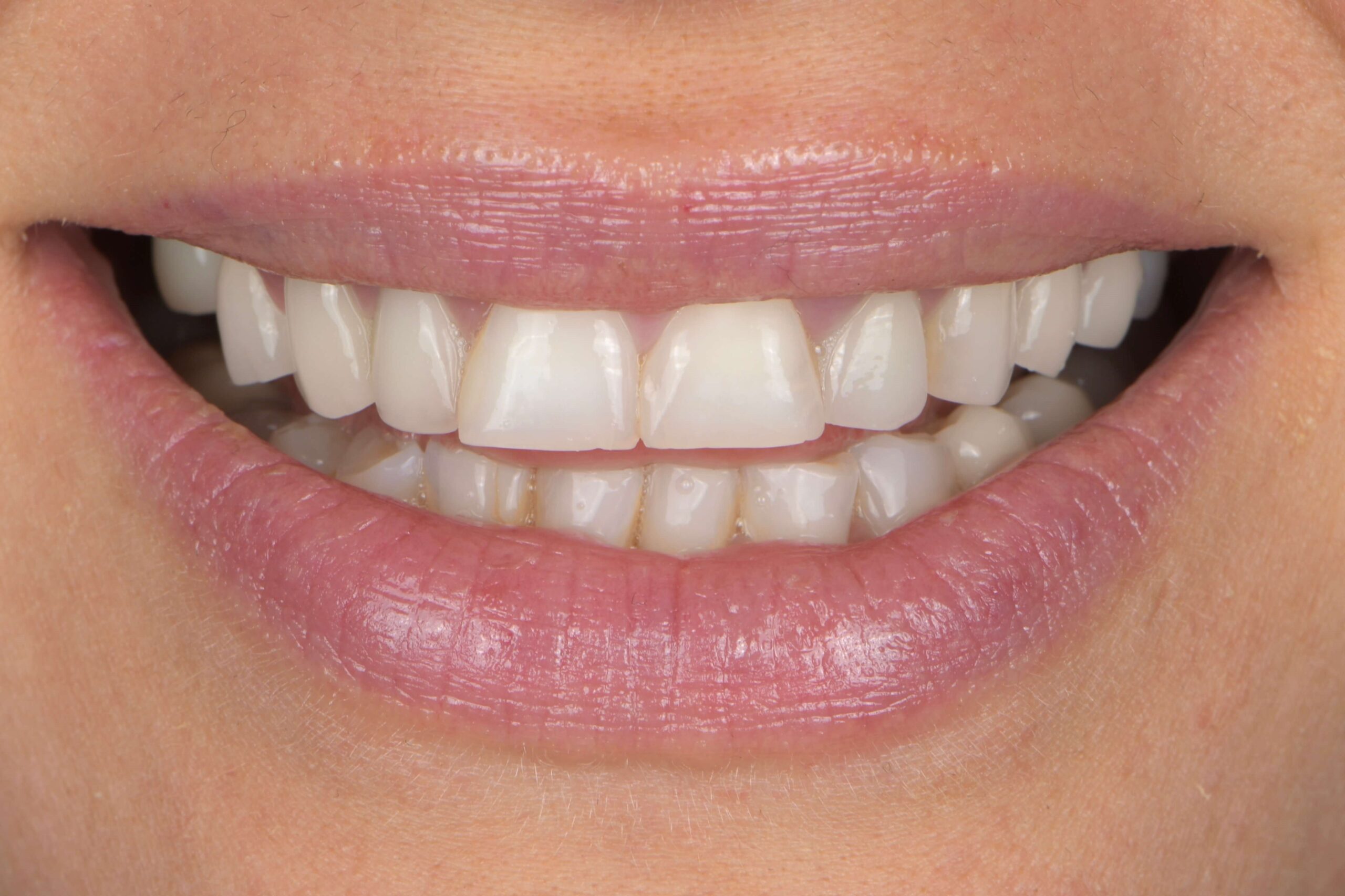 Invisalign® Treatment — before