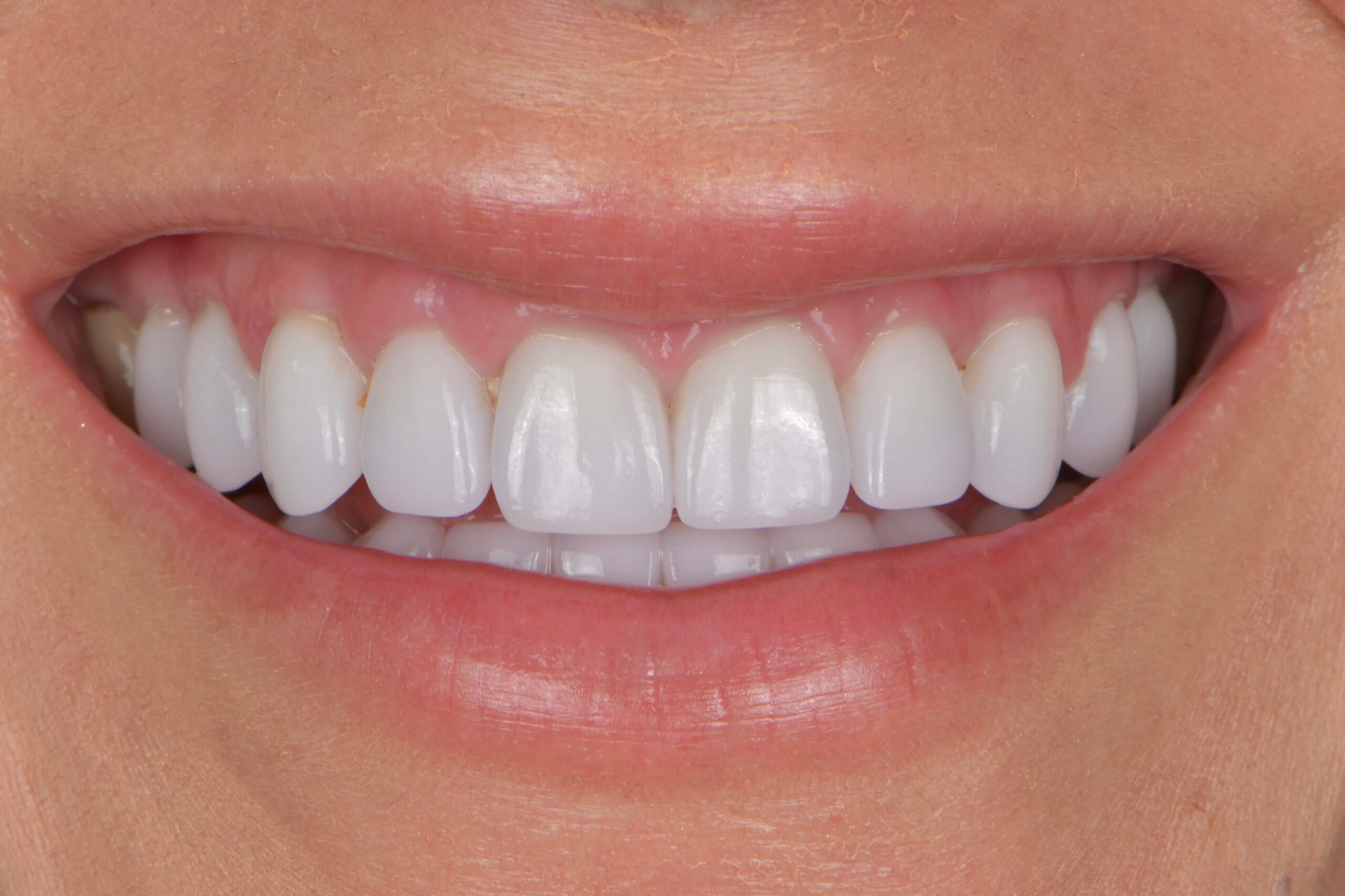 Smile Makeover — after