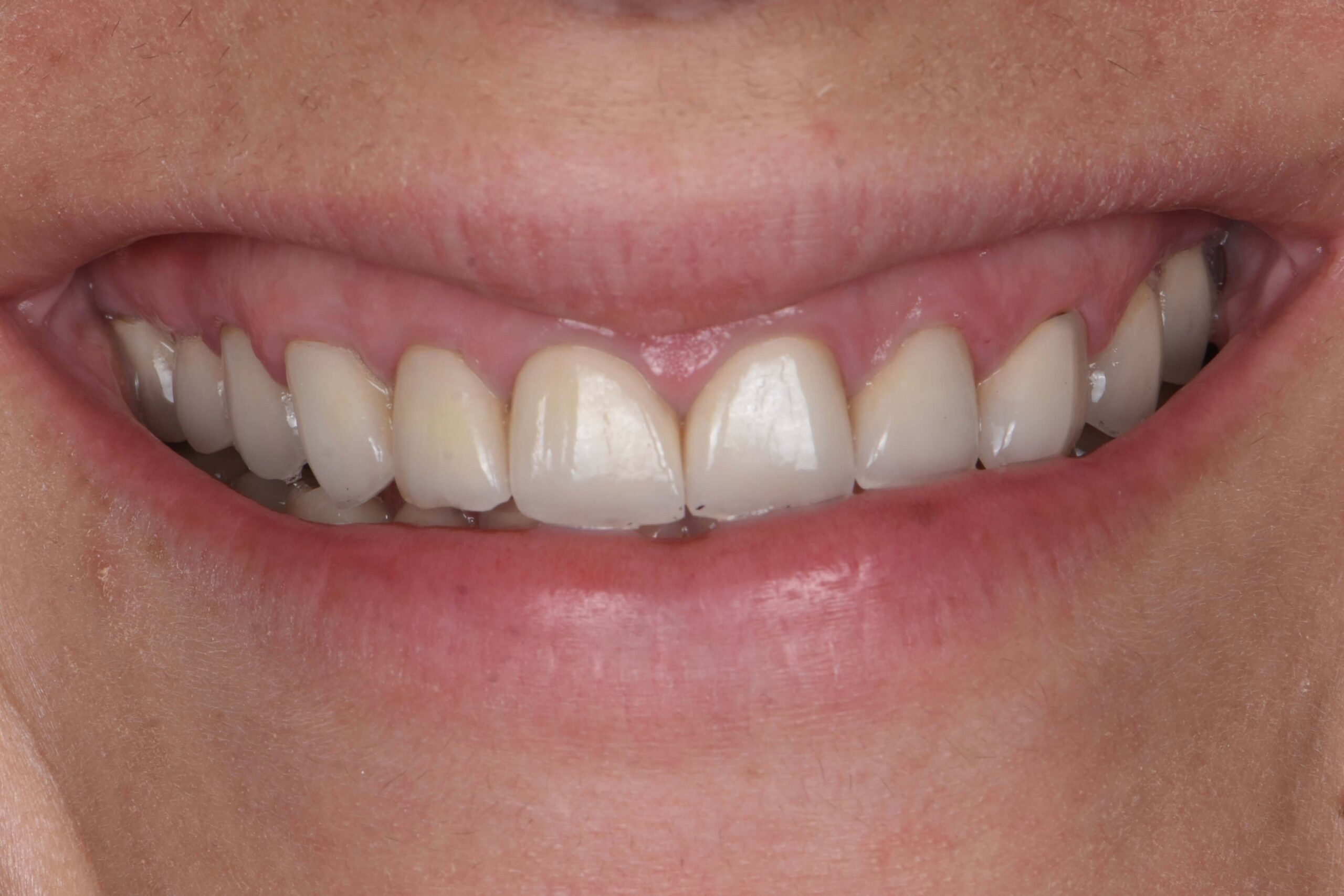 Smile Makeover — before