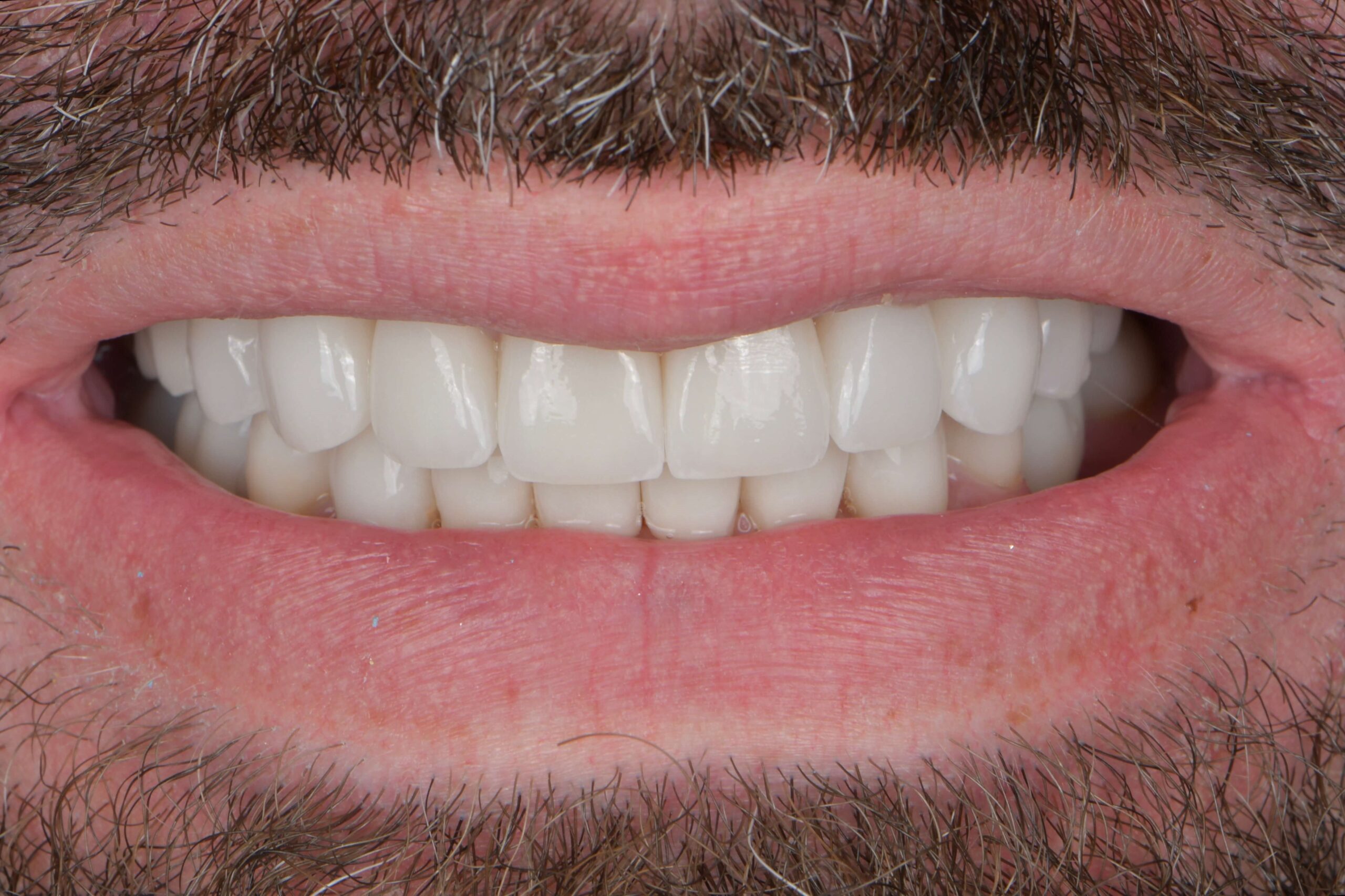 Dental Crowns — after