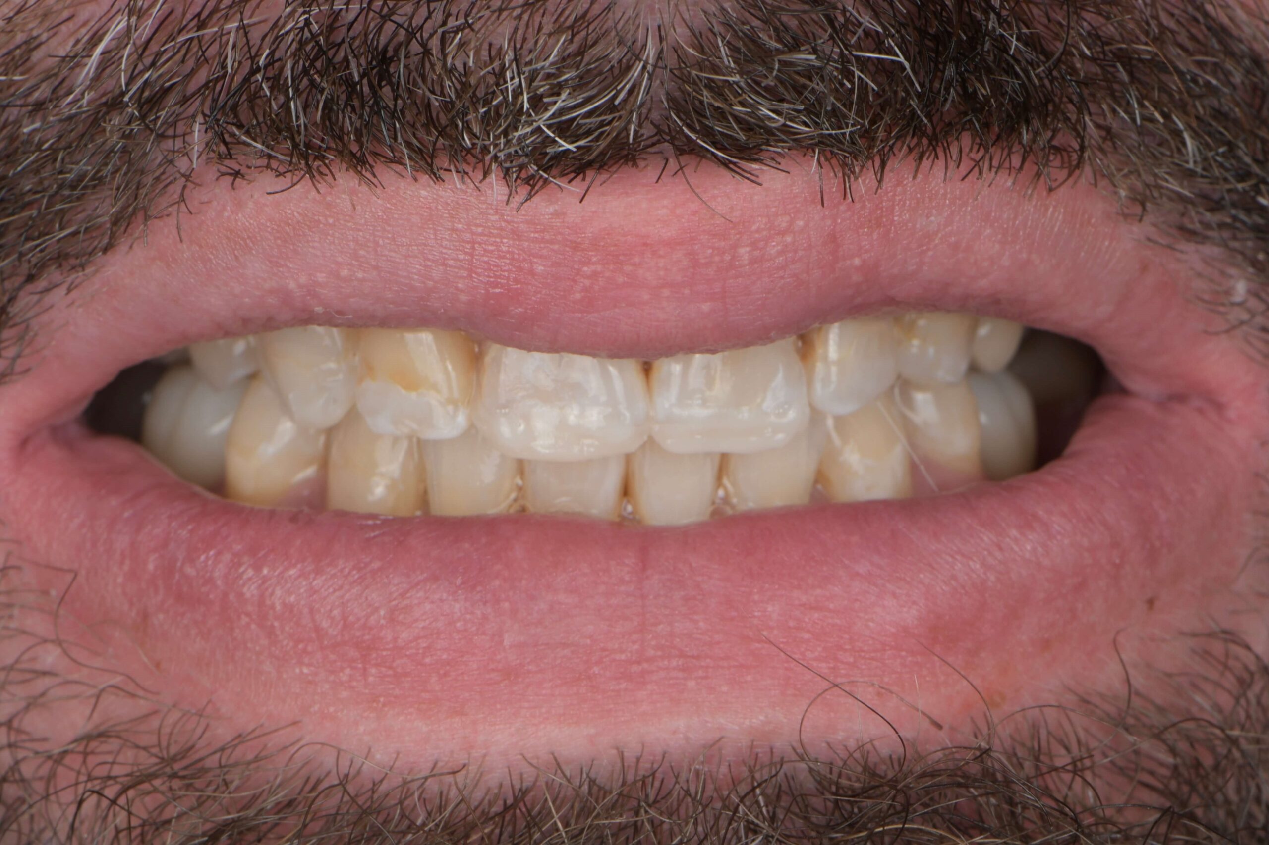 Dental Crowns — before