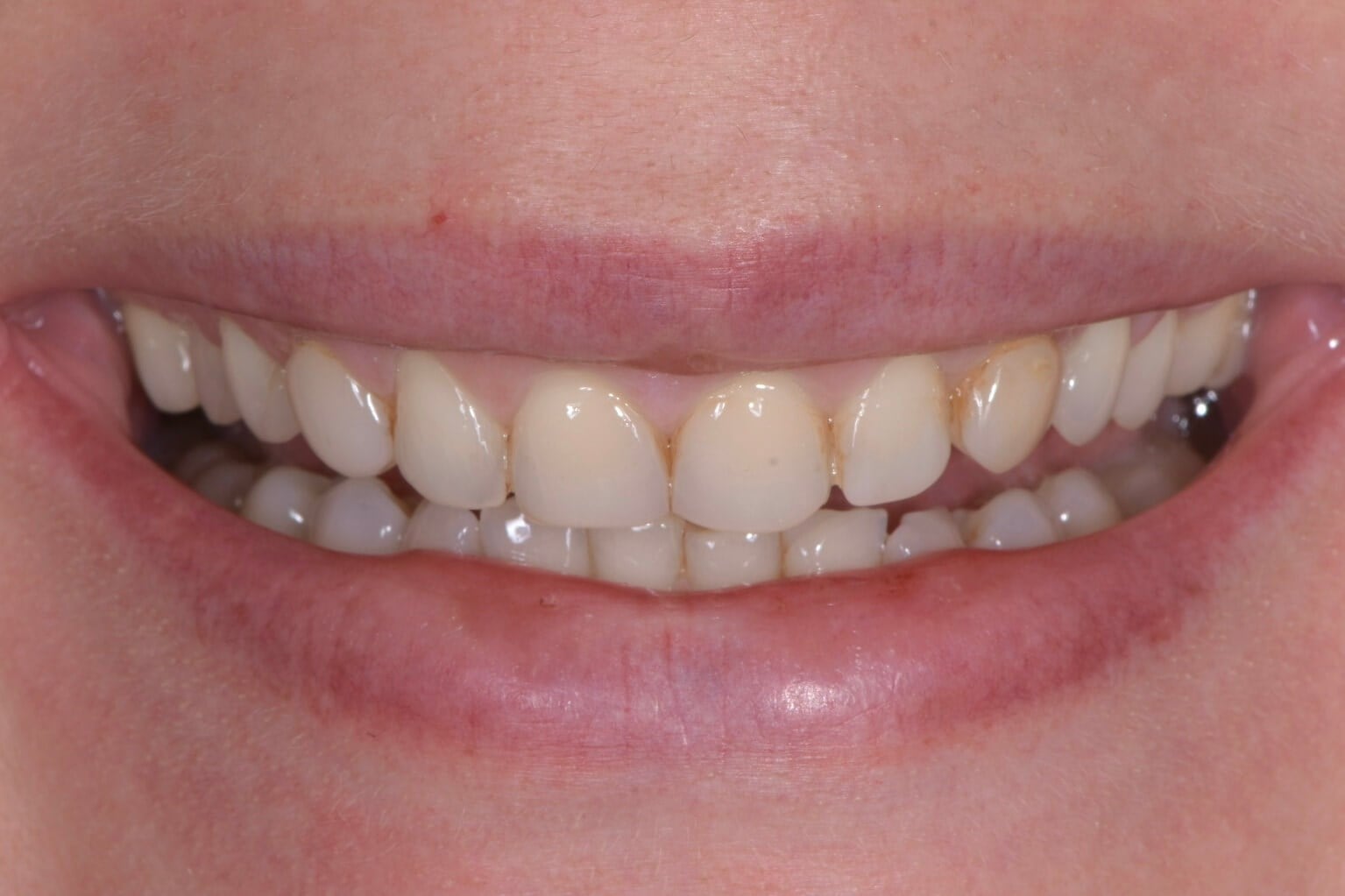 Full-Mouth Rehabilitation — before