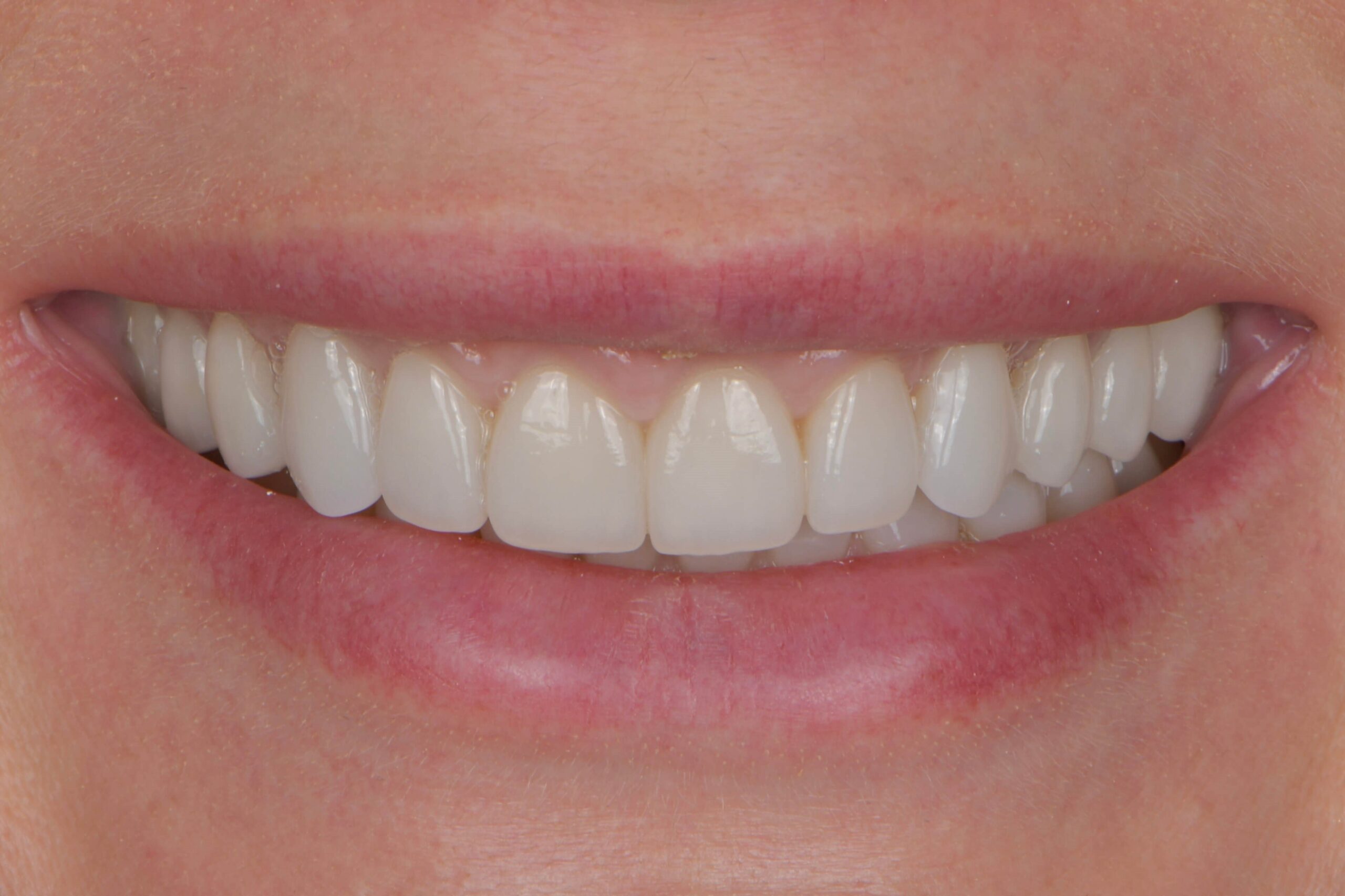 Full-Mouth Rehabilitation — after