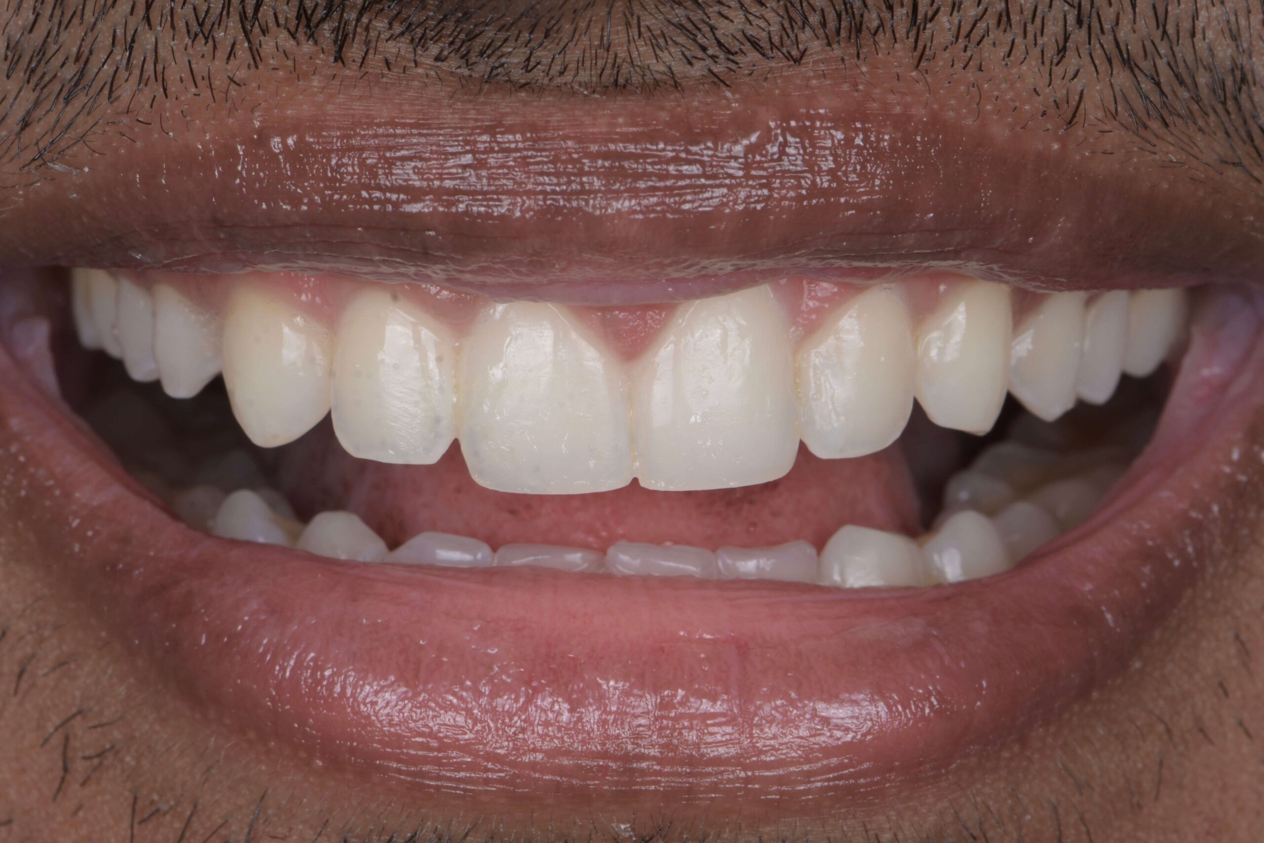 Gum Lift — after