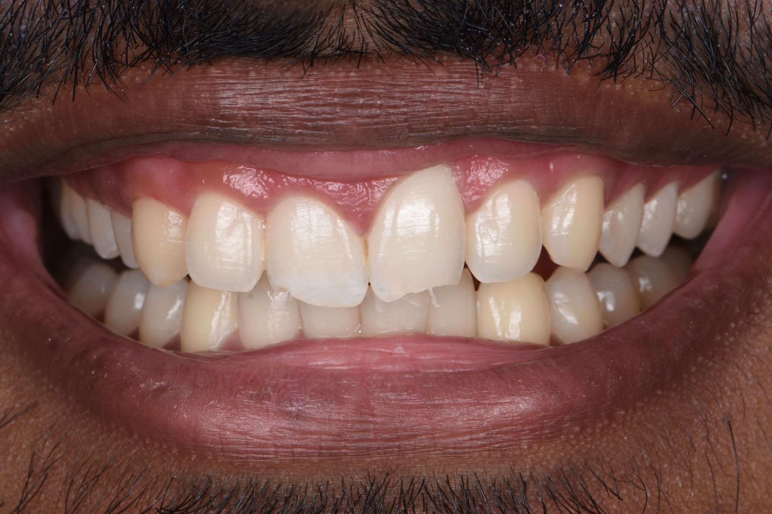 Gum Lift — before