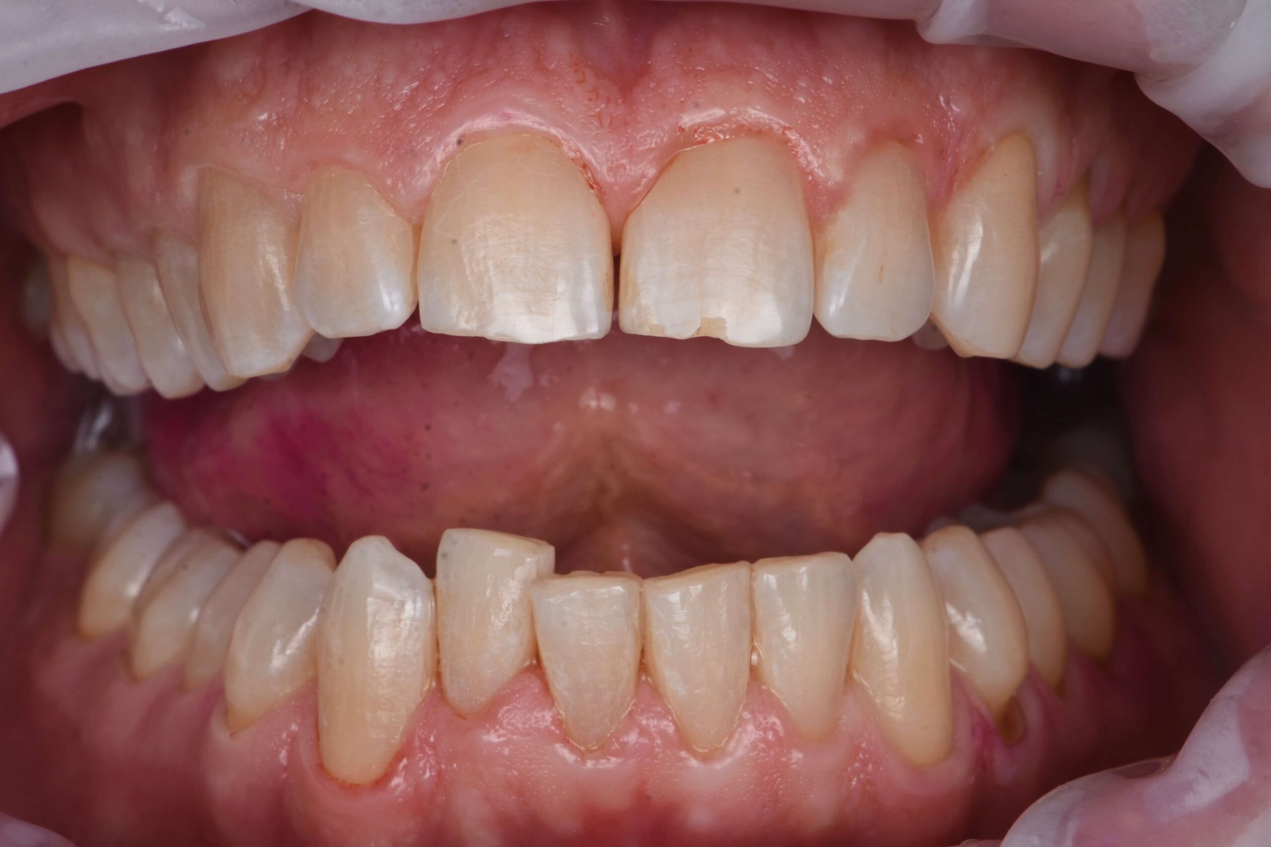 Teeth Polishing — after