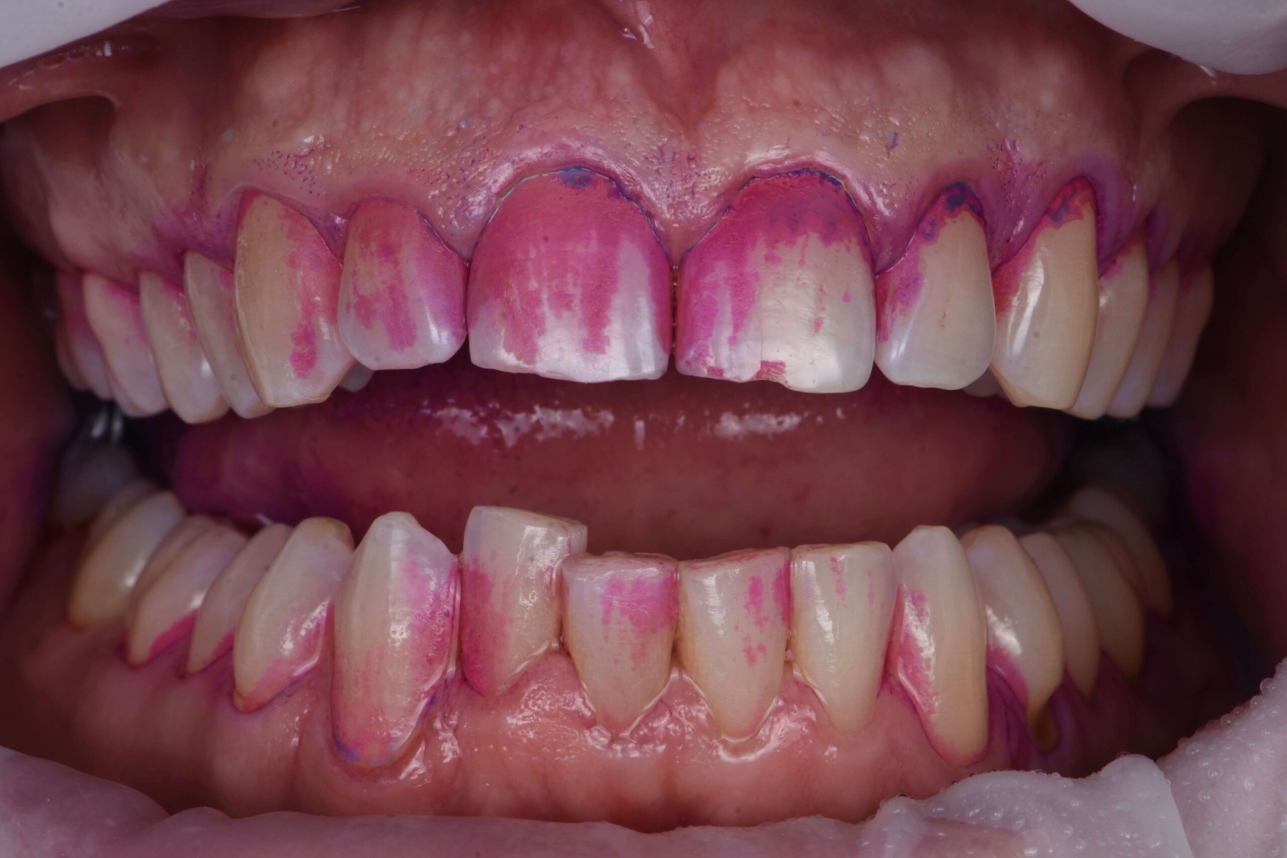 Teeth Polishing — before