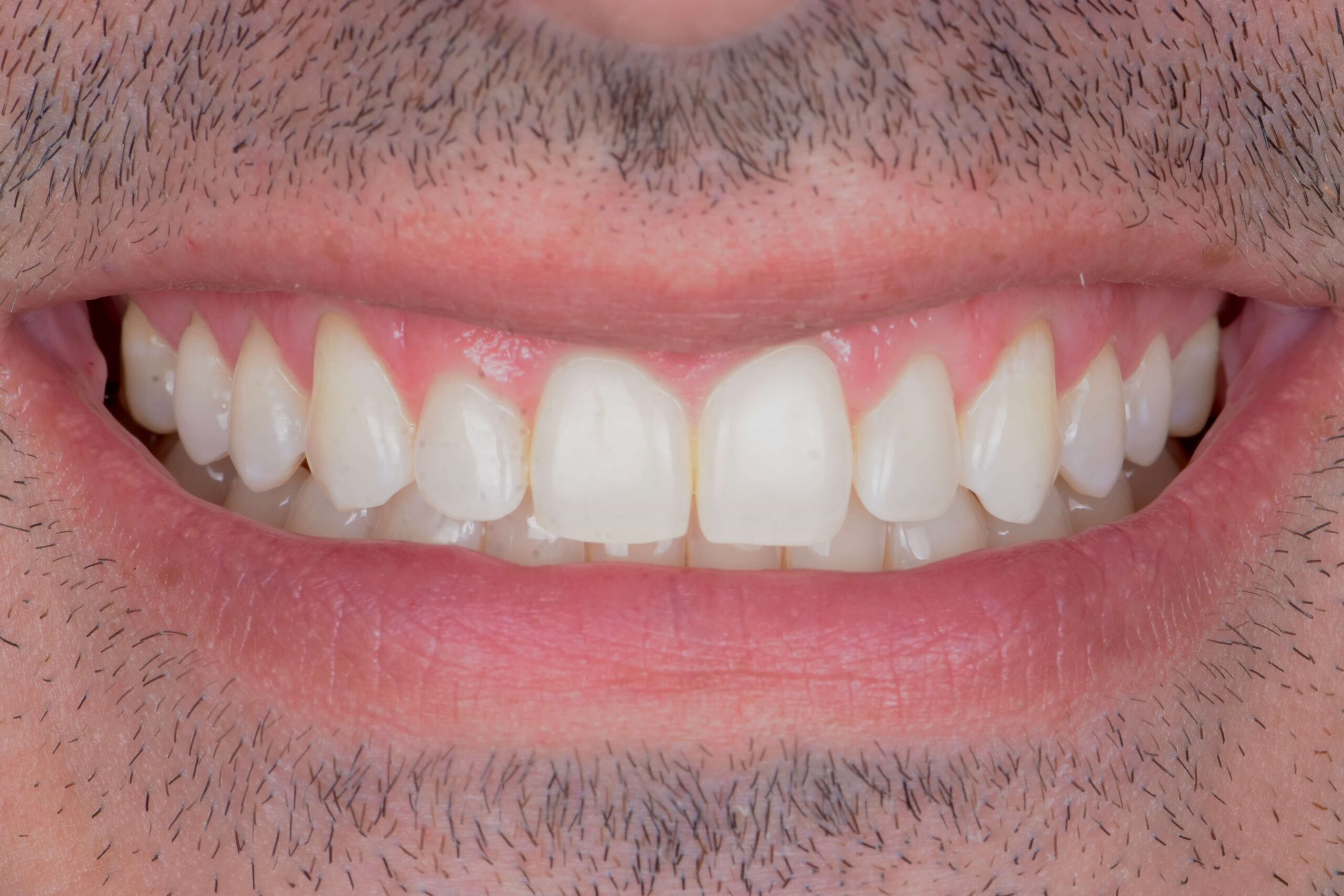 Invisalign® Treatment — after