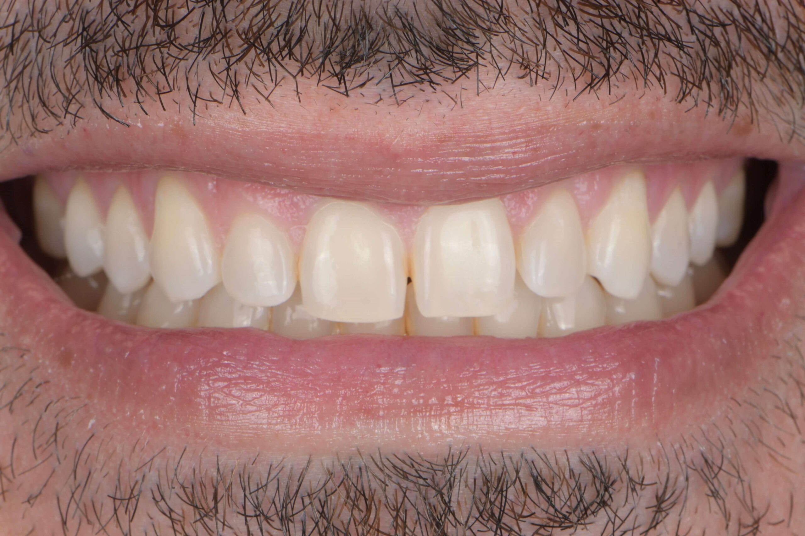 Invisalign® Treatment — before